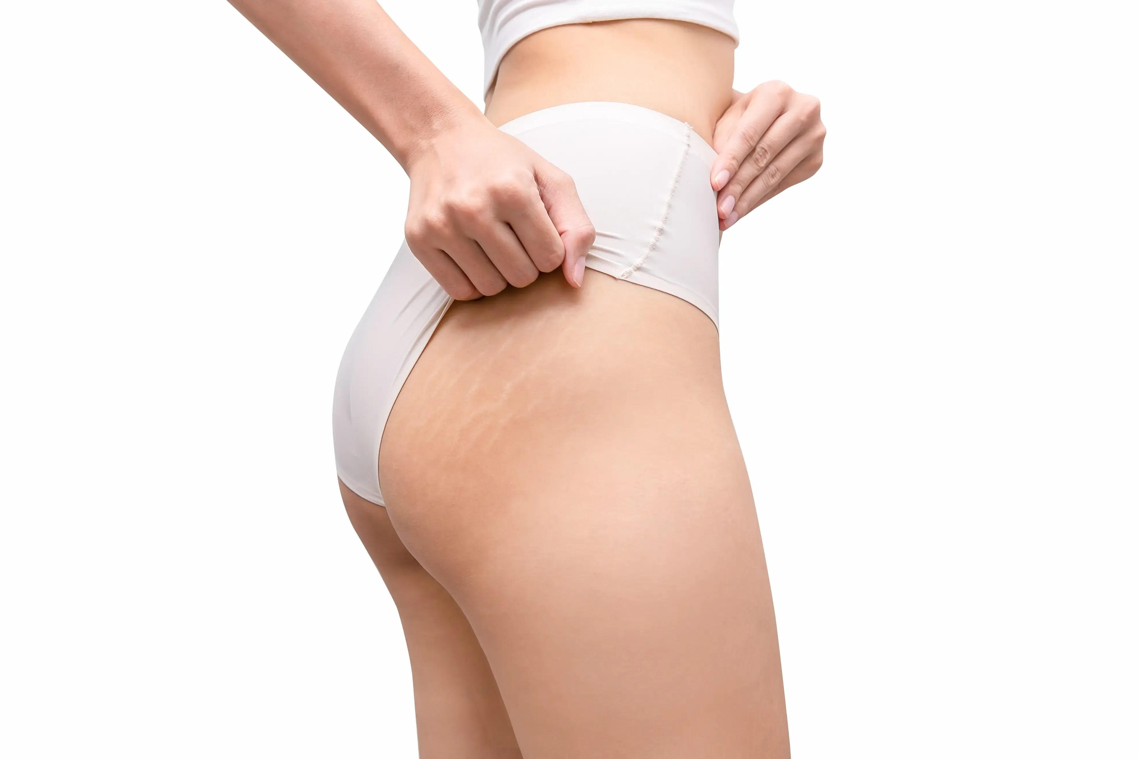 Illustration of dermal collagen tearing during stretch mark formation at Heritage Wellness & Med Spa Crescent Springs