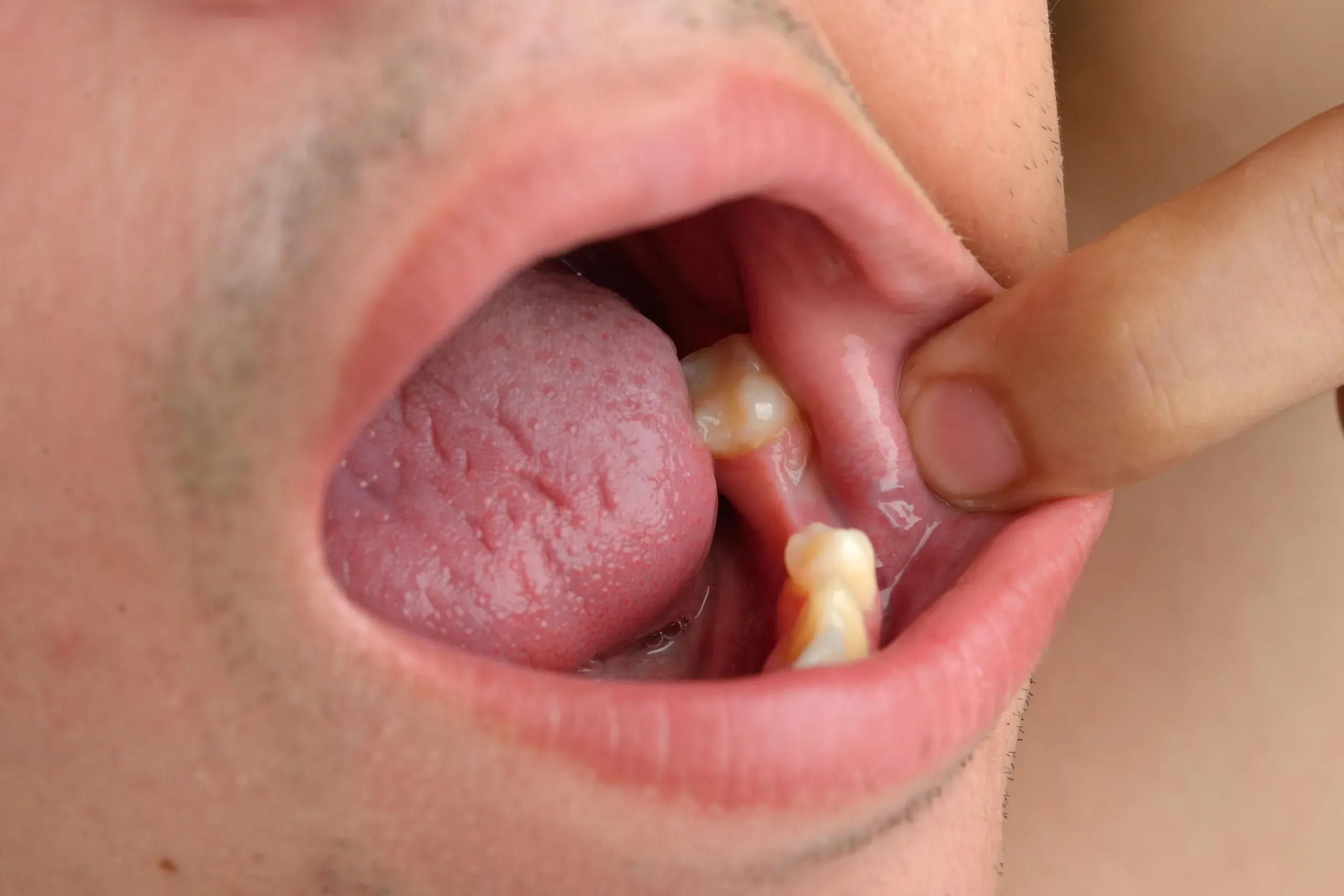 Anatomical illustration showing healthy and missing tooth sites