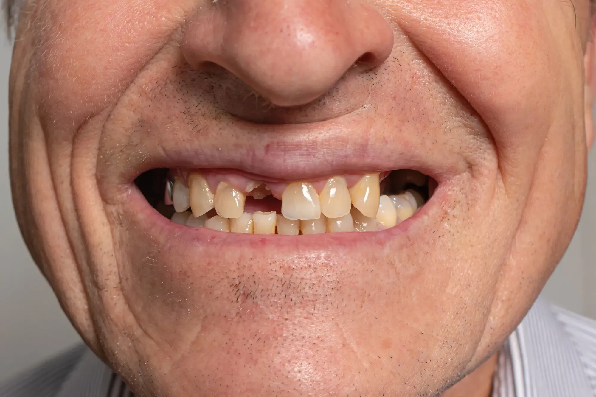 Side-by-side comparison of jawbone with and without tooth replacement
