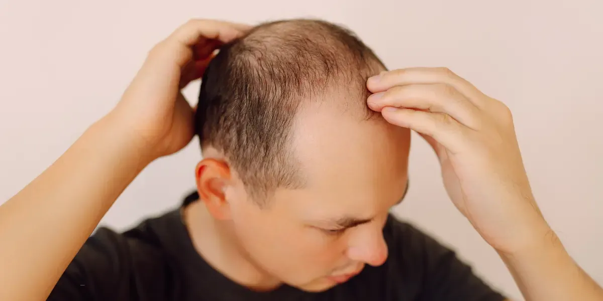 Norwood Scale Stages 1–7 and Best Treatments