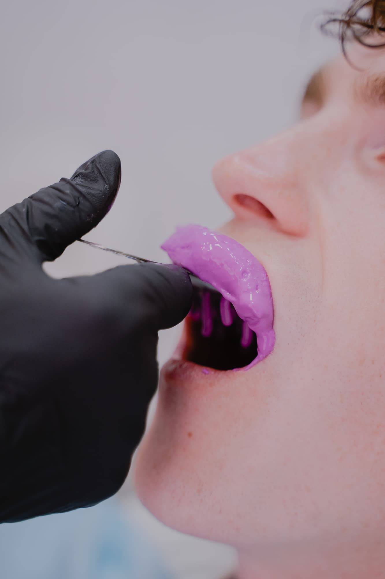 Dental bonding before and after results at Enclave Dental Lake Mary FL