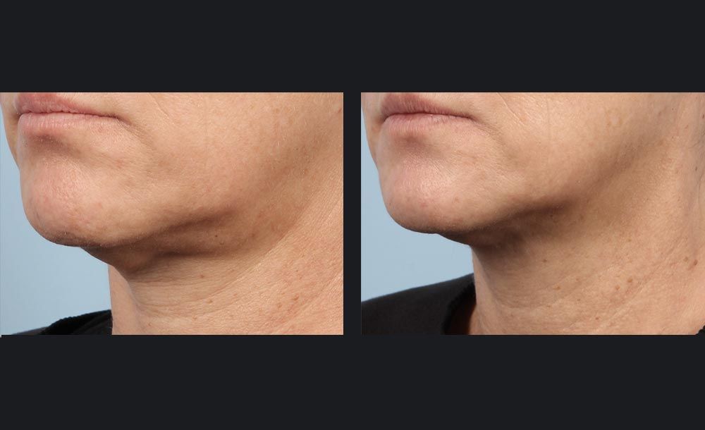 Sublative RF with Candela Matrix - Before and After