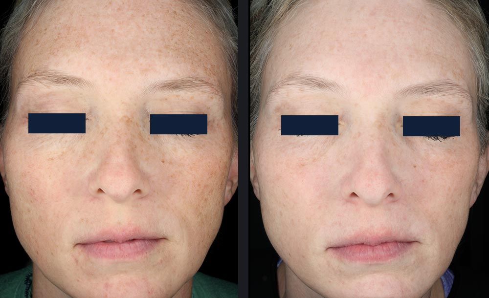 Sublative RF with Candela Matrix - Before and After