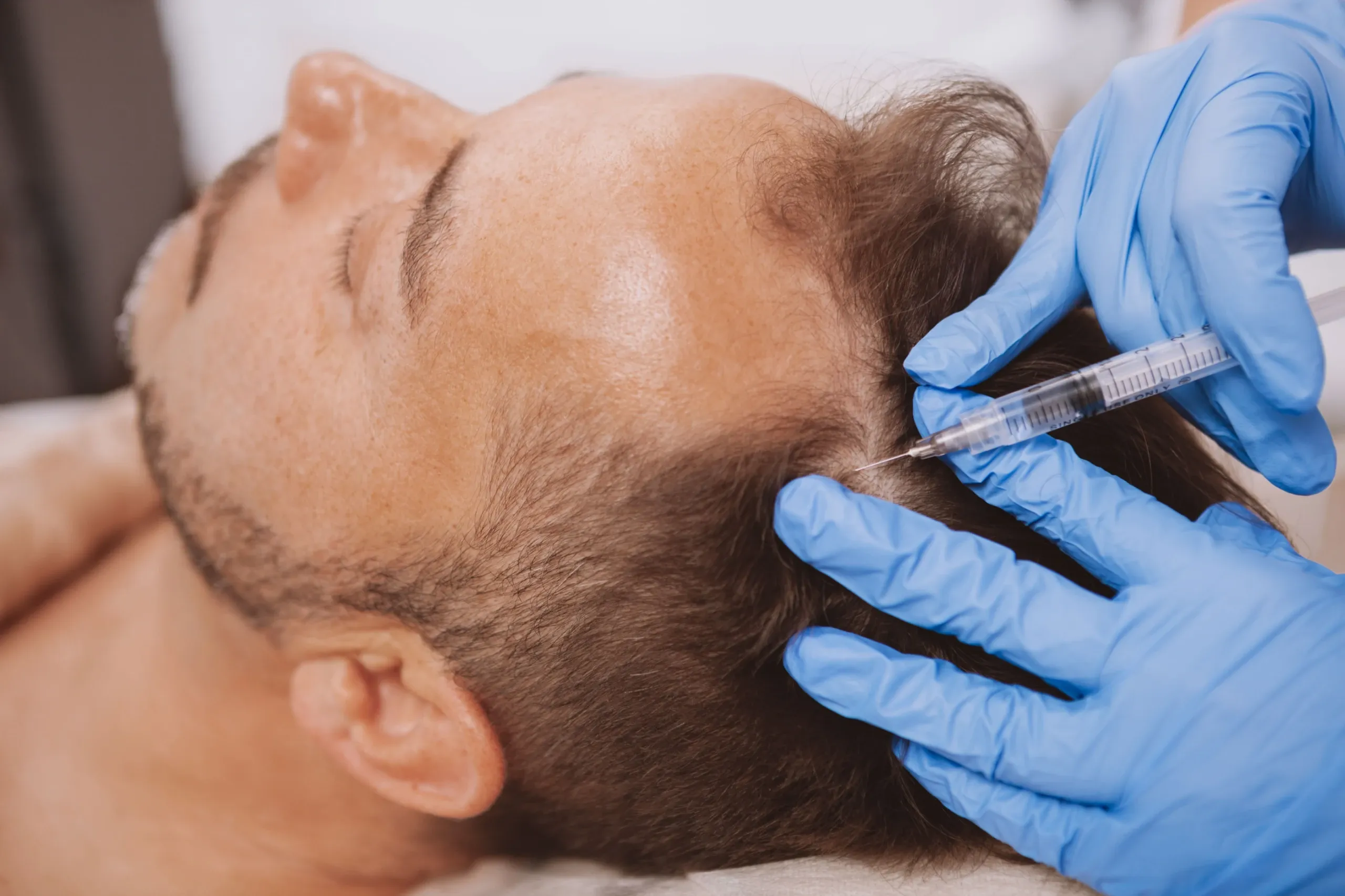 PRP for Thinning Hair: Everything You Need to Know