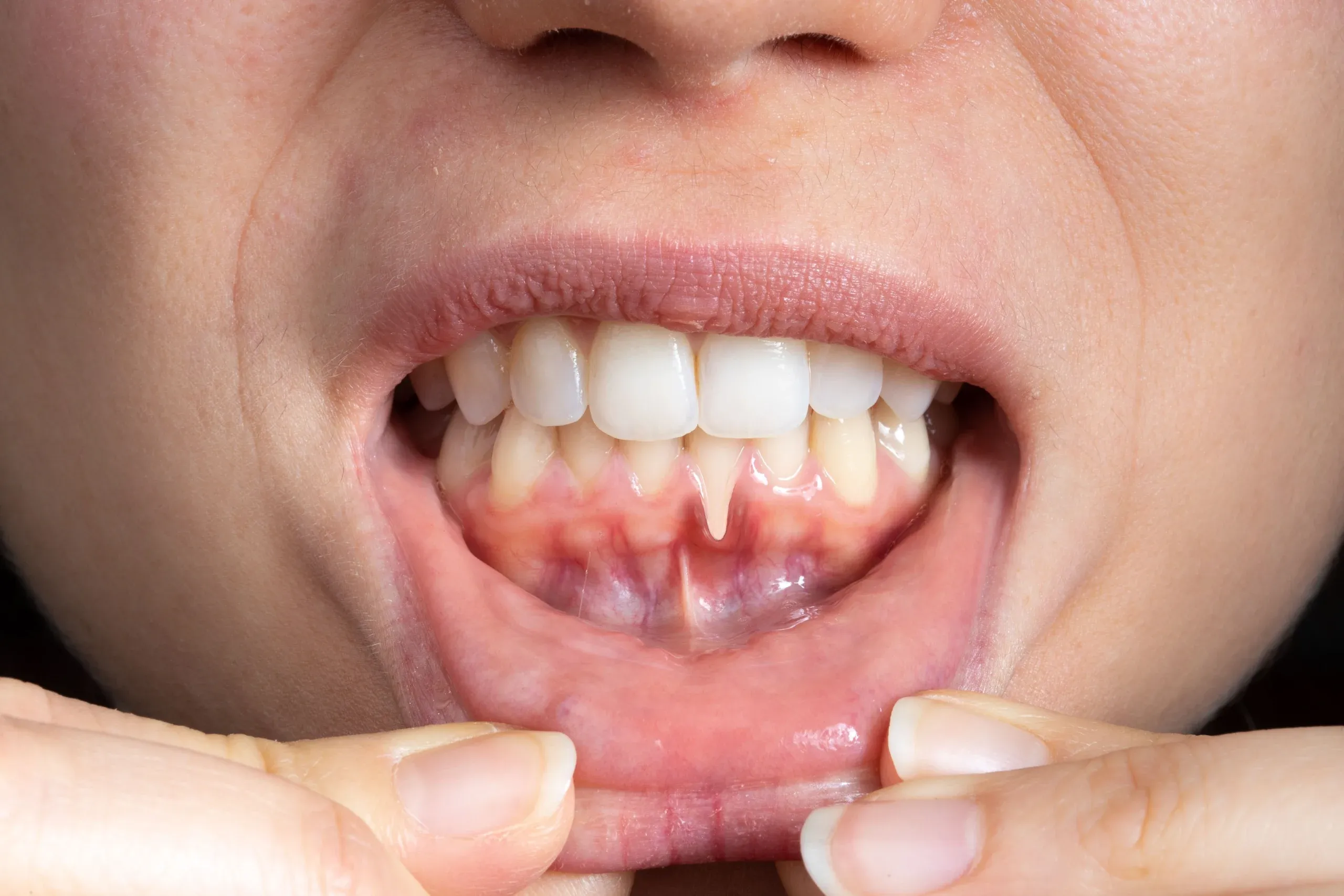 <span class="text-accent">Receding Gums</span> in Santa Rosa Beach, FL