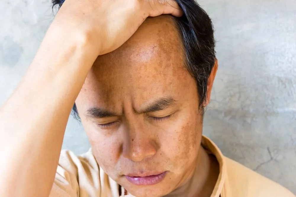 Is Topical Finasteride as Effective as Oral? A Complete Comparison