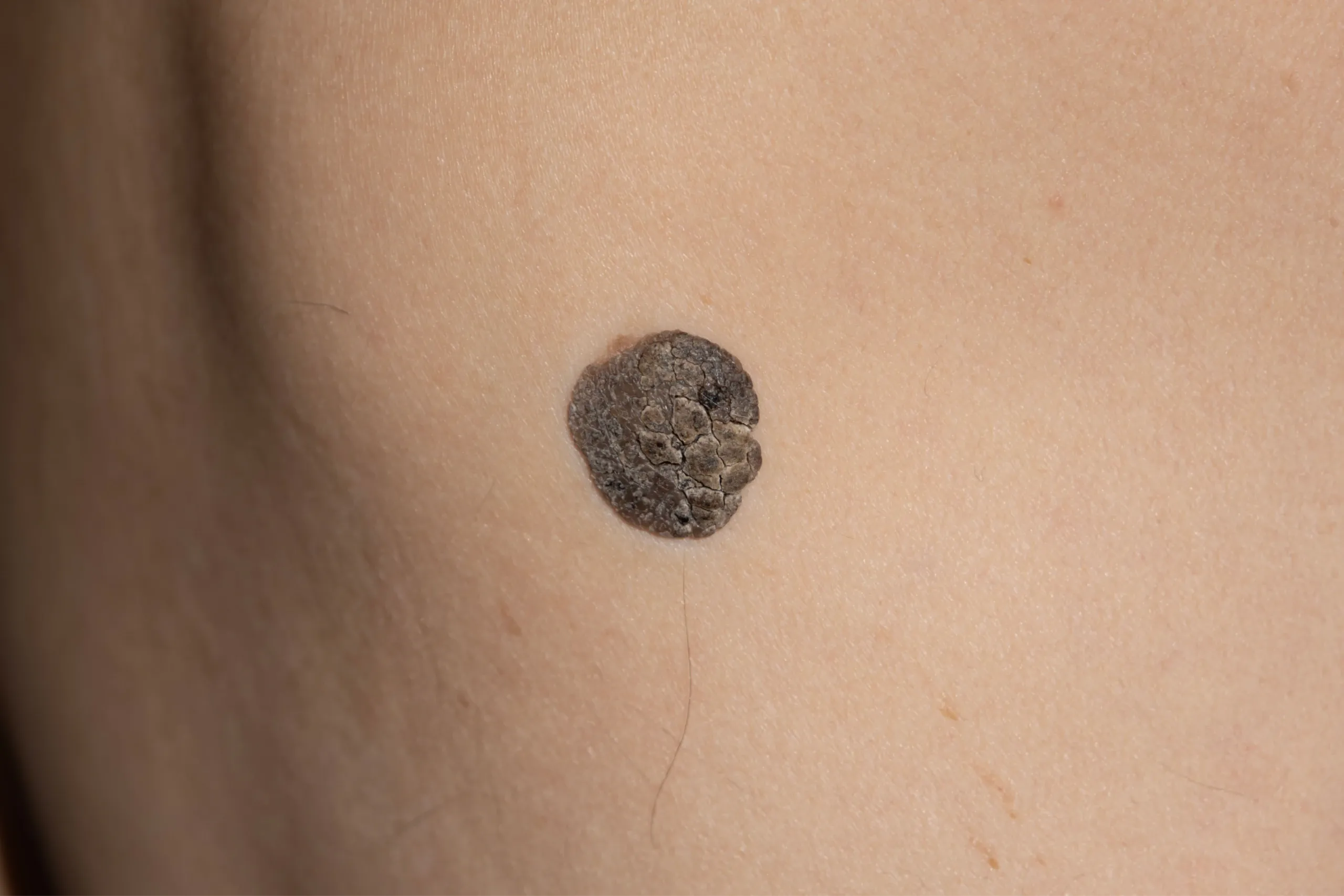 physician reviewing skin lesion treatment plan with patient Venice FL