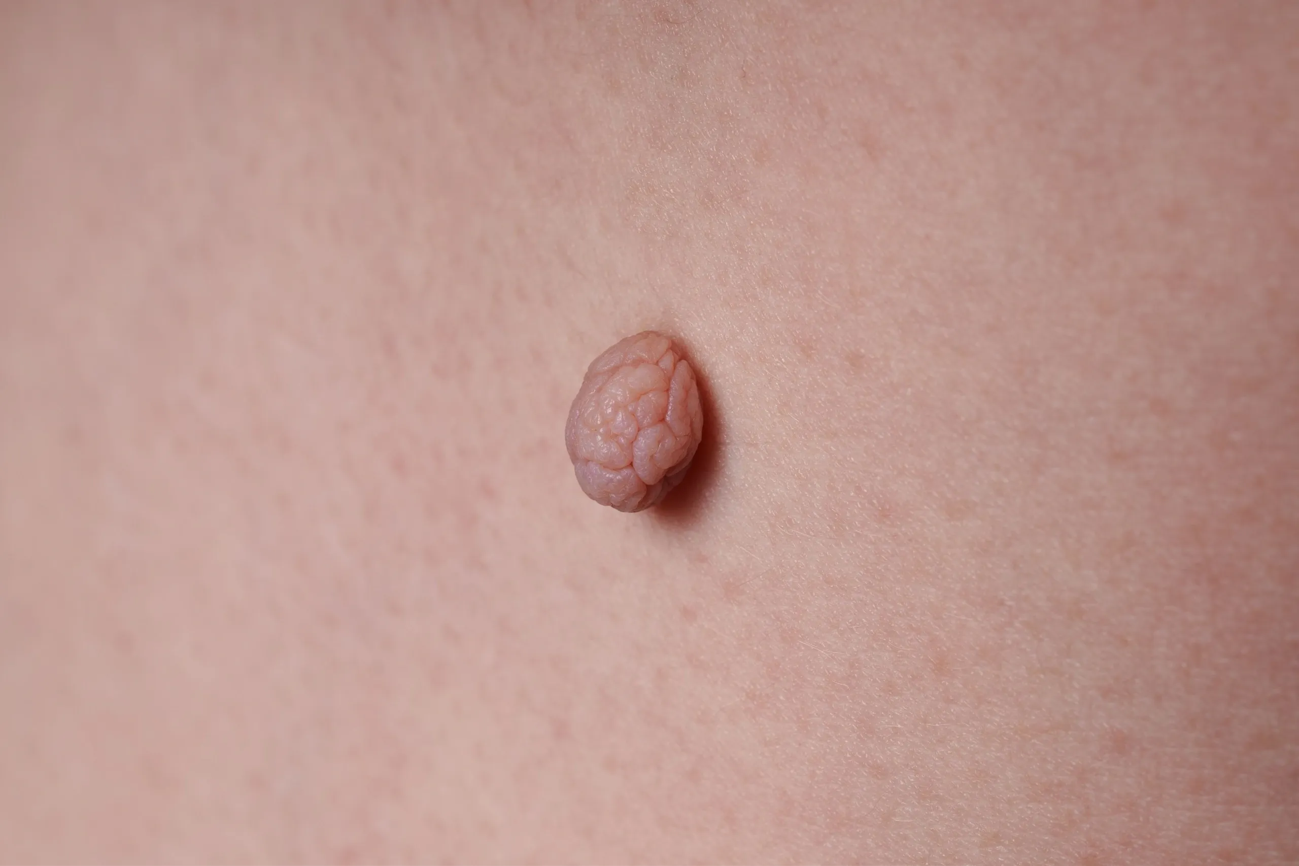 illustration of common benign skin growths and lesions at Paradise Family Healthcare Venice FL