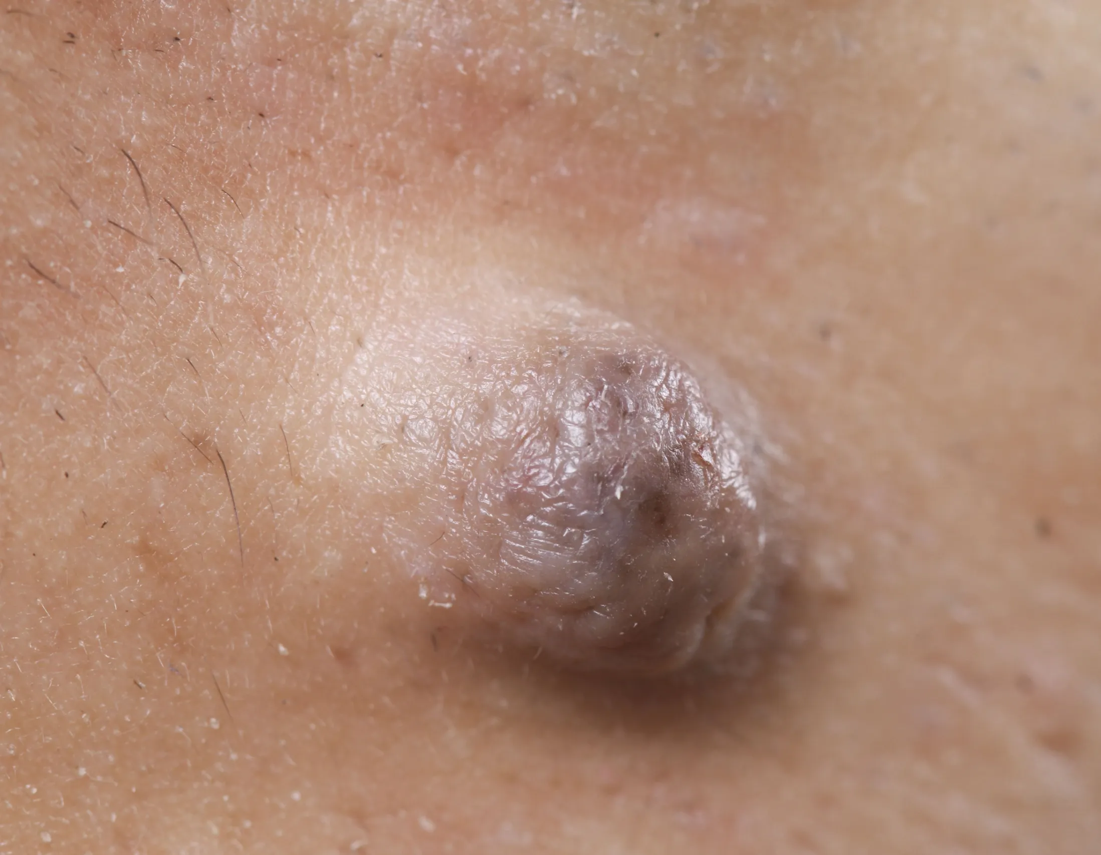 close up examination of skin tag wart and mole at Paradise Family Healthcare Venice FL