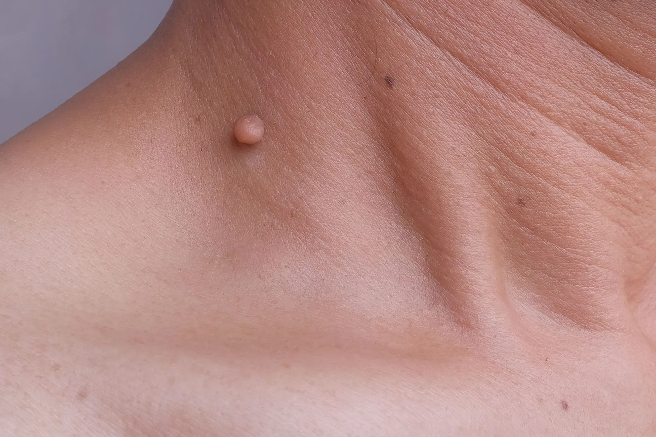 skin lesions treatment consultation Paradise Family Healthcare Venice FL