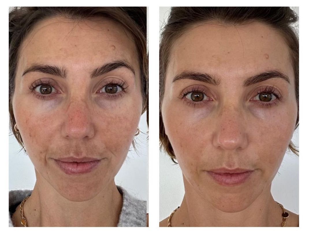 Microneedling - Before and After