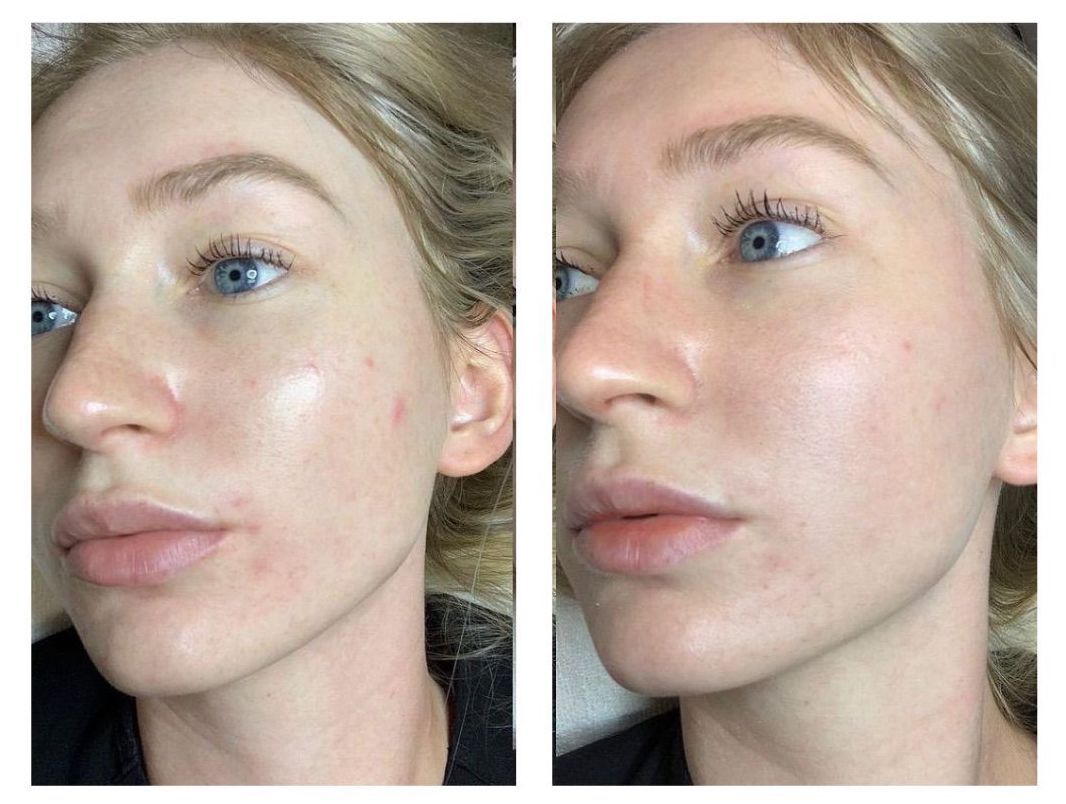 Microneedling - Before and After