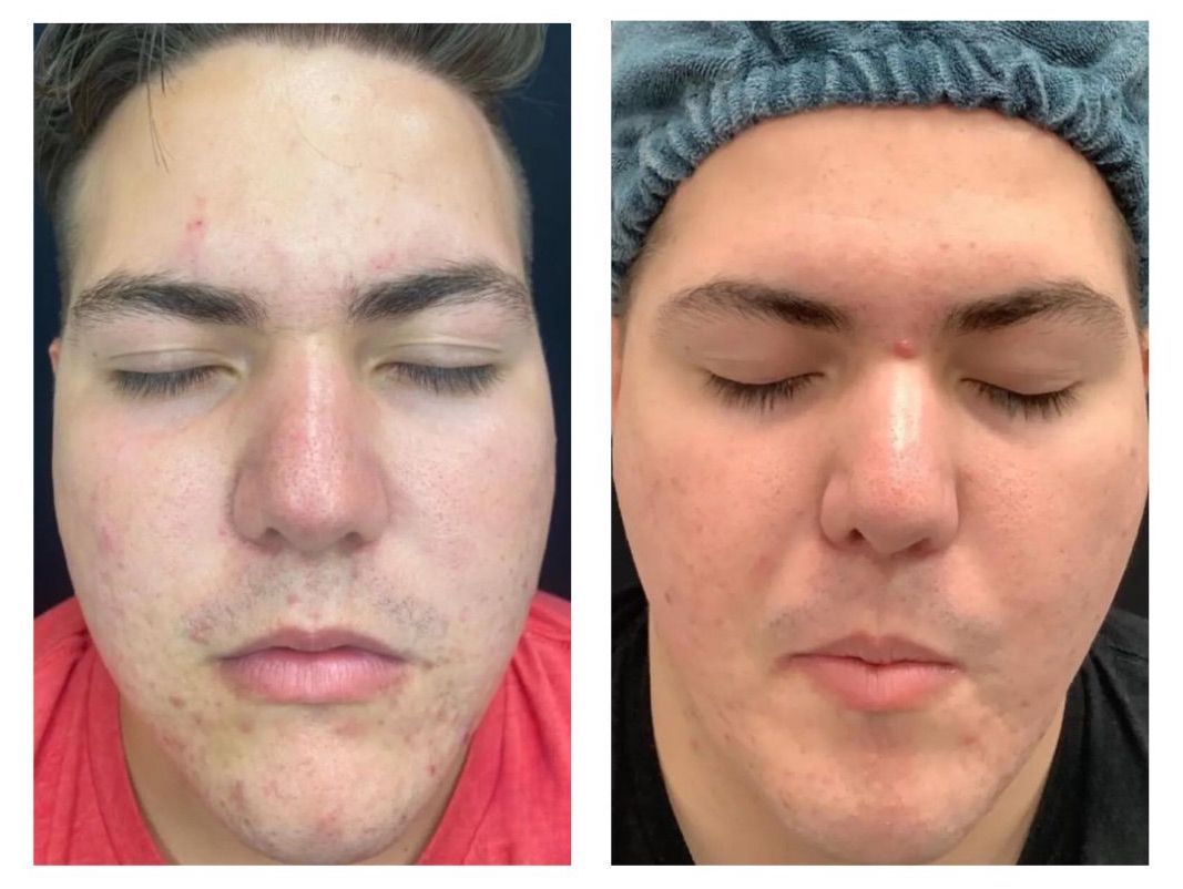 Microneedling - Before and After