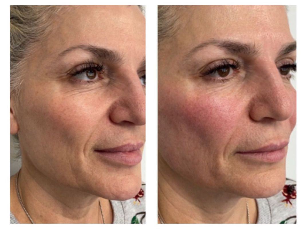 Microneedling - Before and After