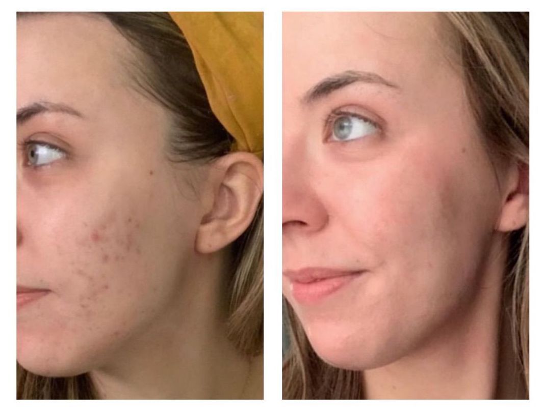 Microneedling - Before and After