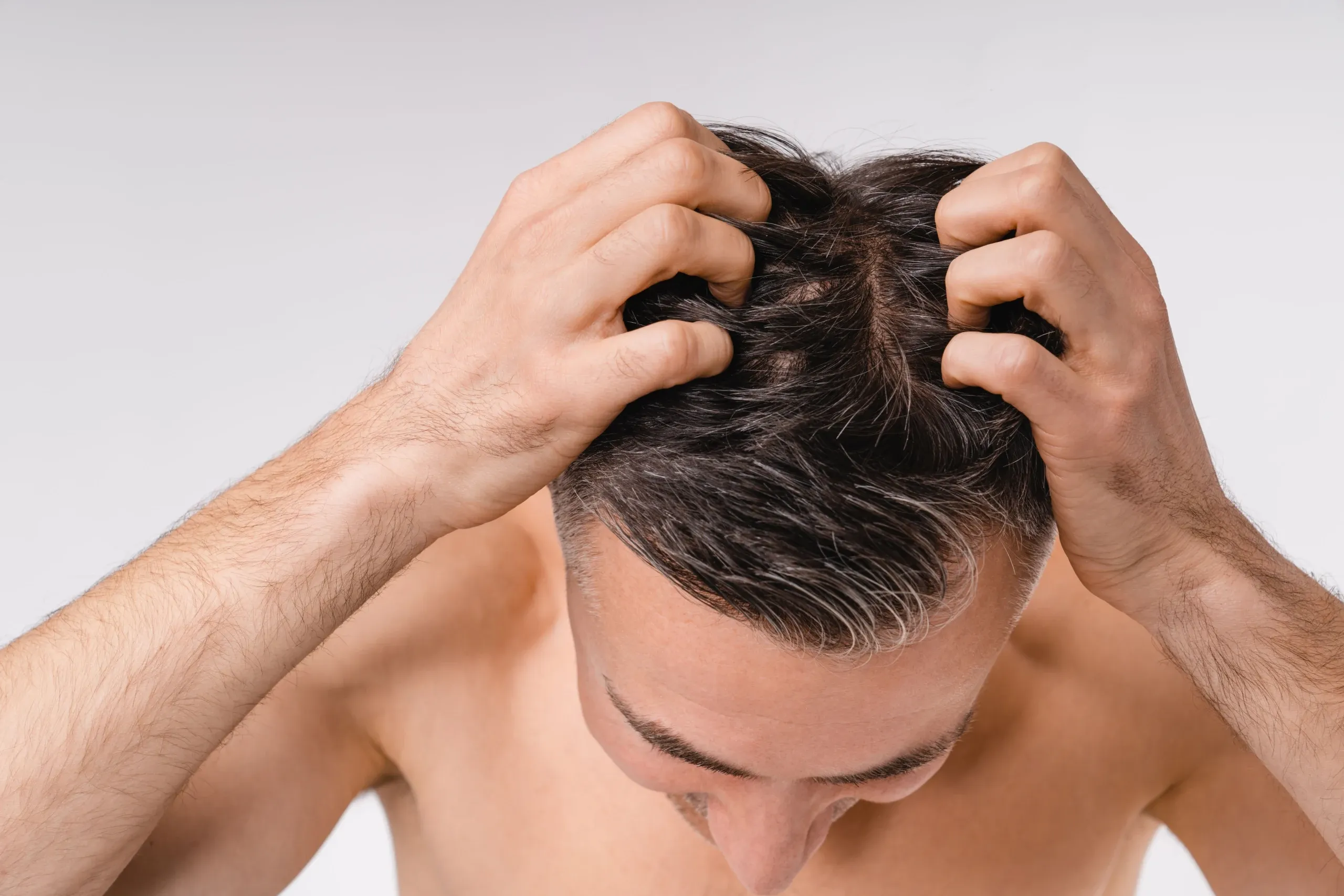 Stress and Hair Loss: How to Manage Stress for Healthier Hair