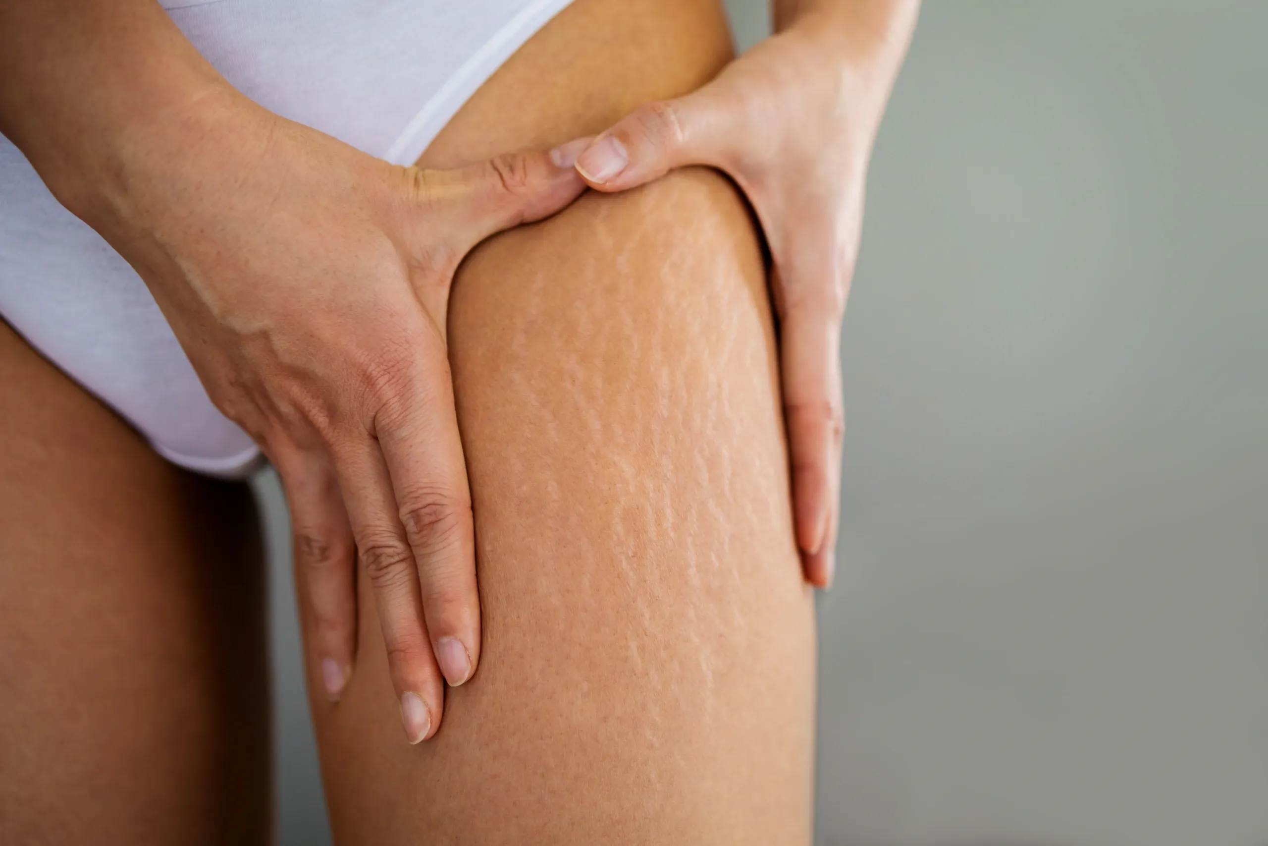 Patient examining stretch marks at Heritage Wellness & Med Spa Crescent Springs