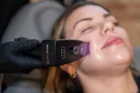 Morpheus8 RF Microneedling