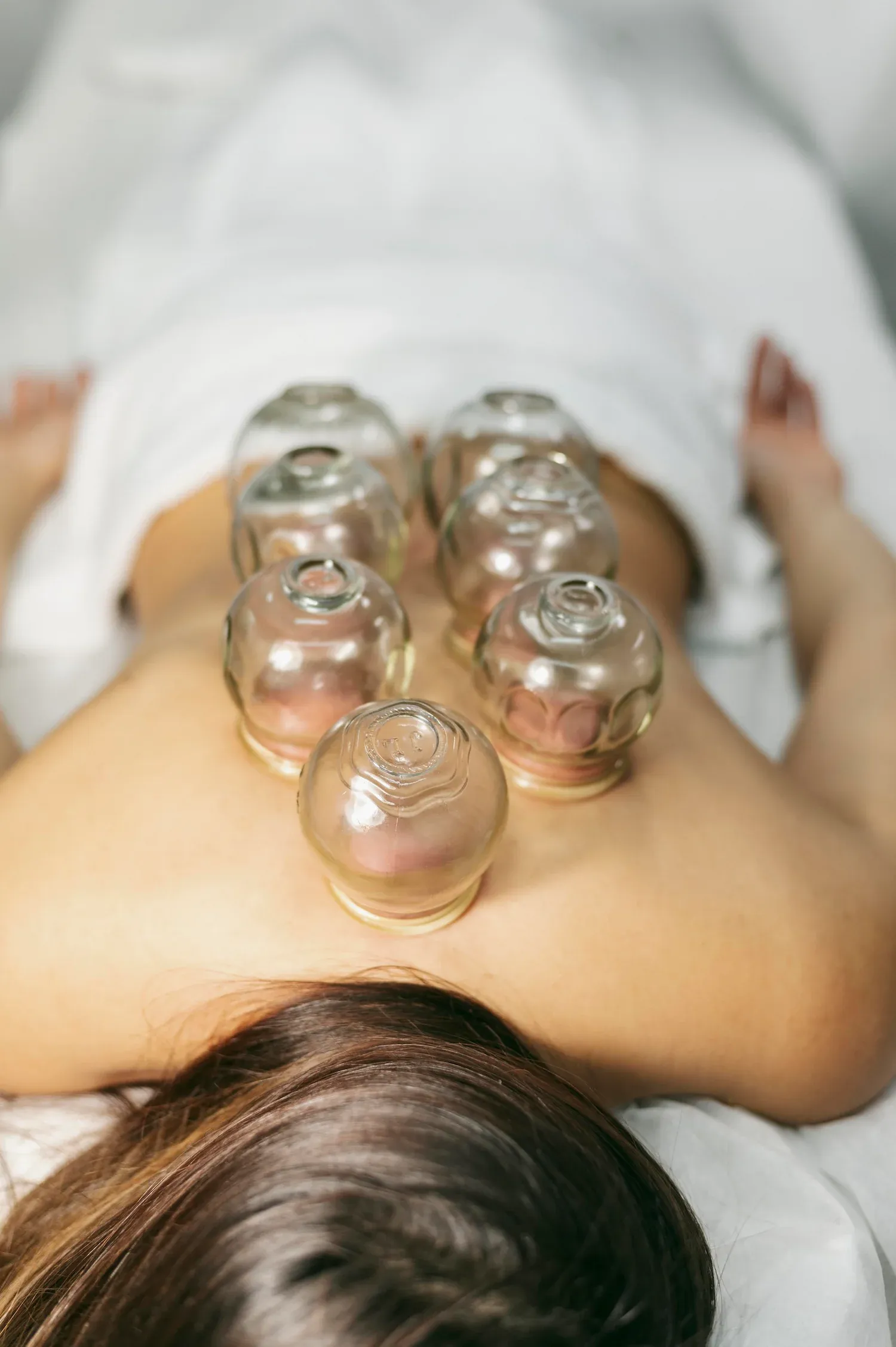 Patient consultation about cupping therapy benefits at Bensa Chiropractic Bradenton