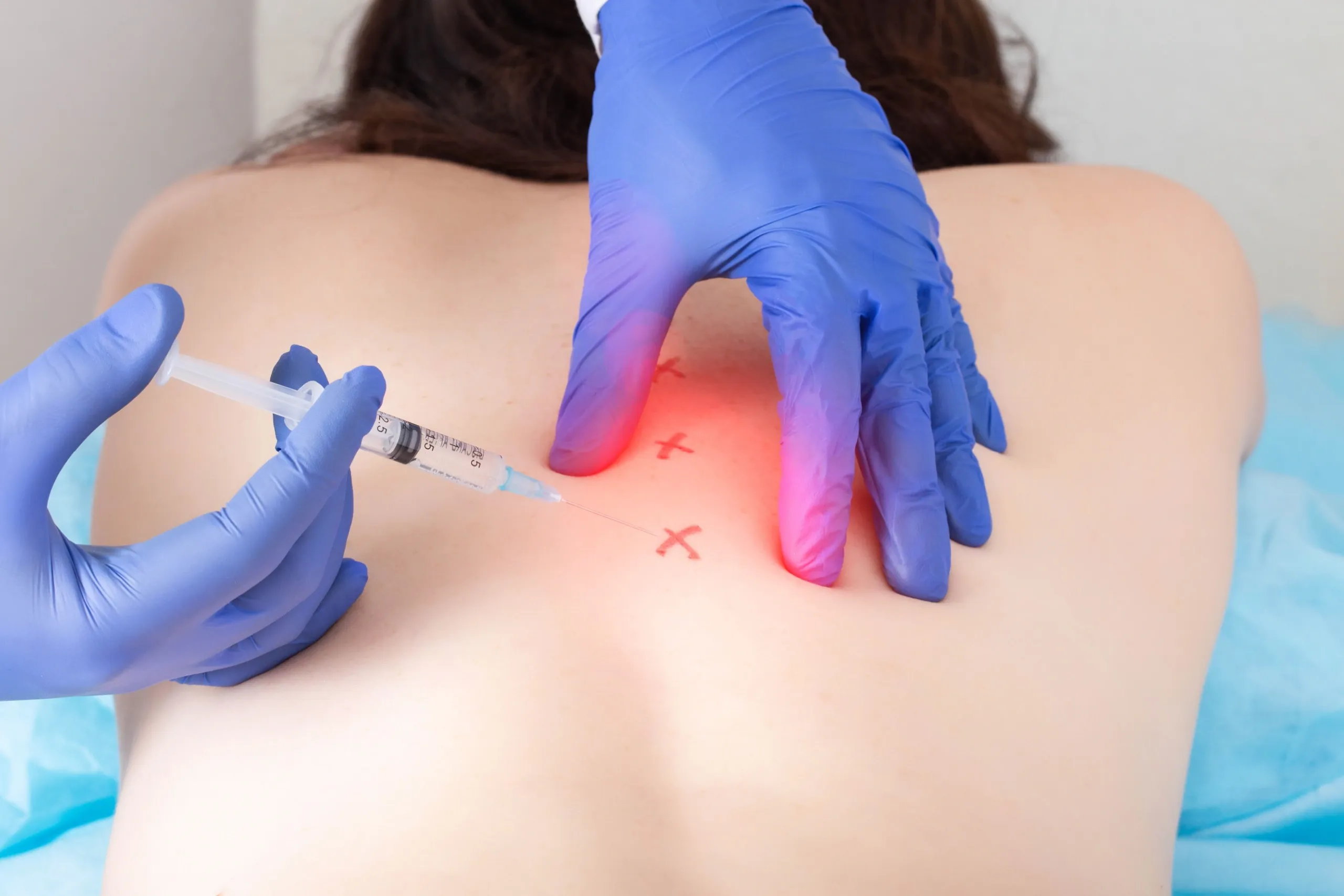 Trigger Point Injections