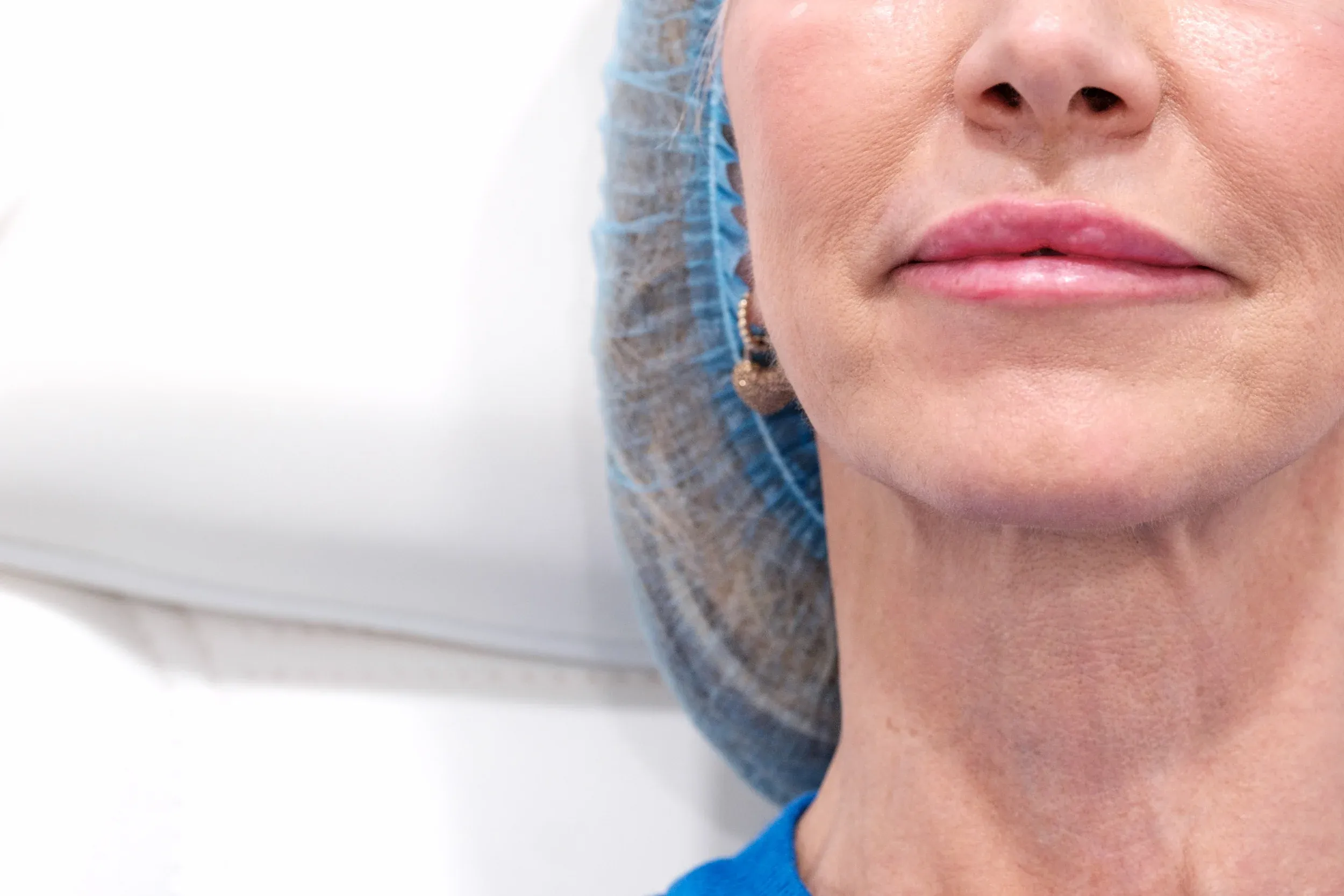 Lifestyle factors affecting facial volume loss at Mint Aesthetics & Skin Indianapolis