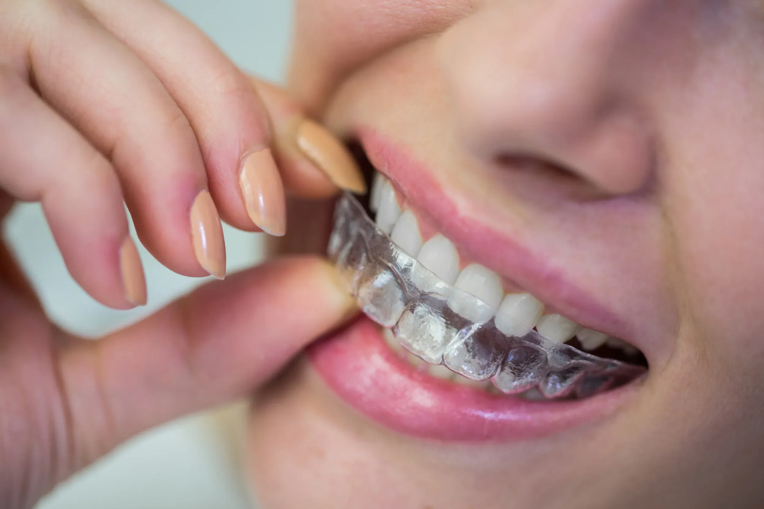 Clear aligner treatment at Dental World in Longwood FL