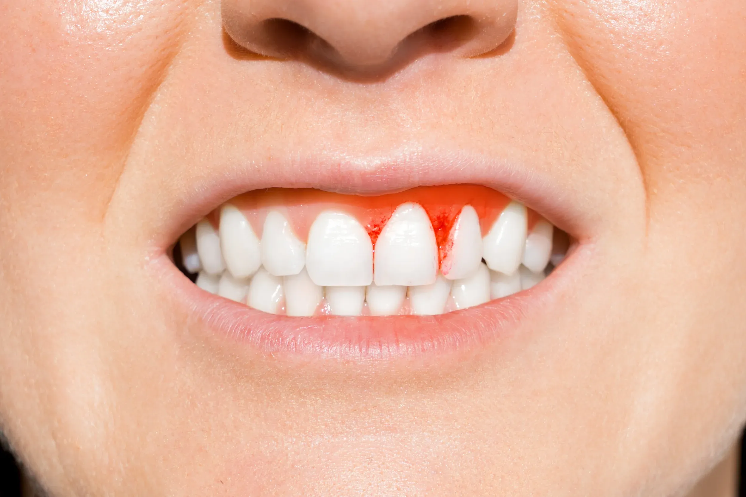 Lifestyle and health factors contributing to bleeding gums at Dental World Longwood FL