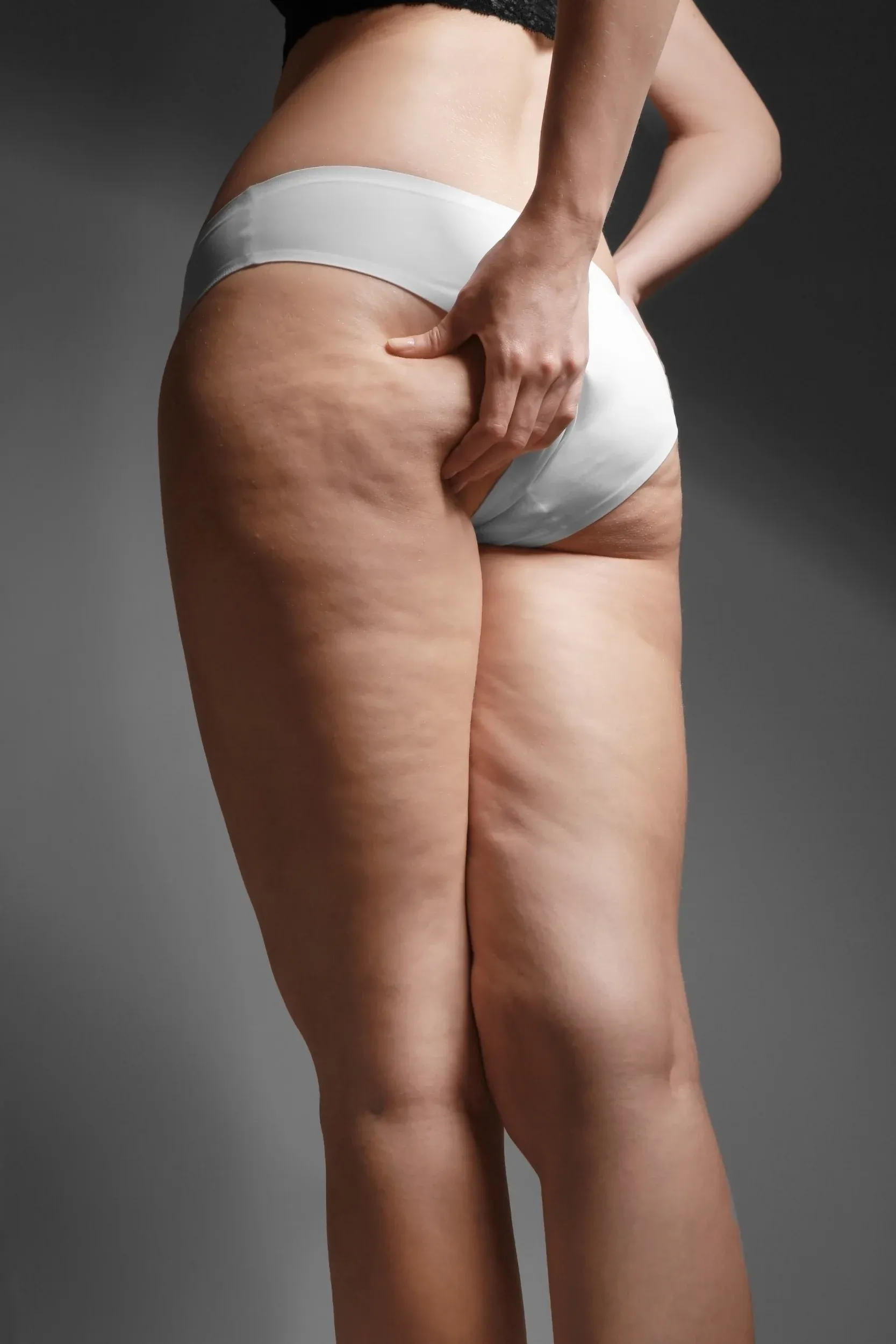 Close-up of cellulite and loose skin on thighs at ProActive Chiropractic and Wellness Center Tampa