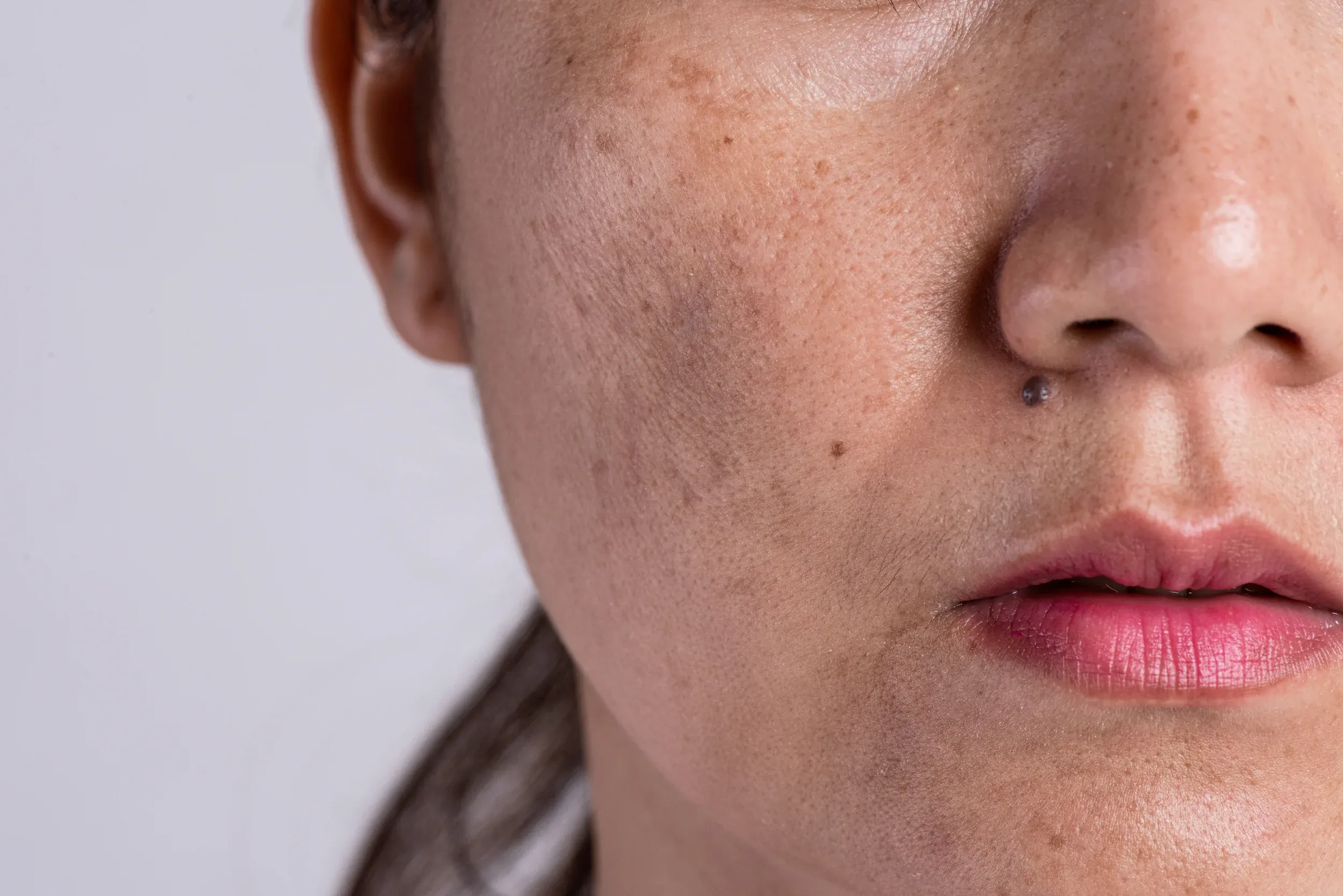 Acne scar treatment guide from Indianapolis skin experts at Mint Aesthetics