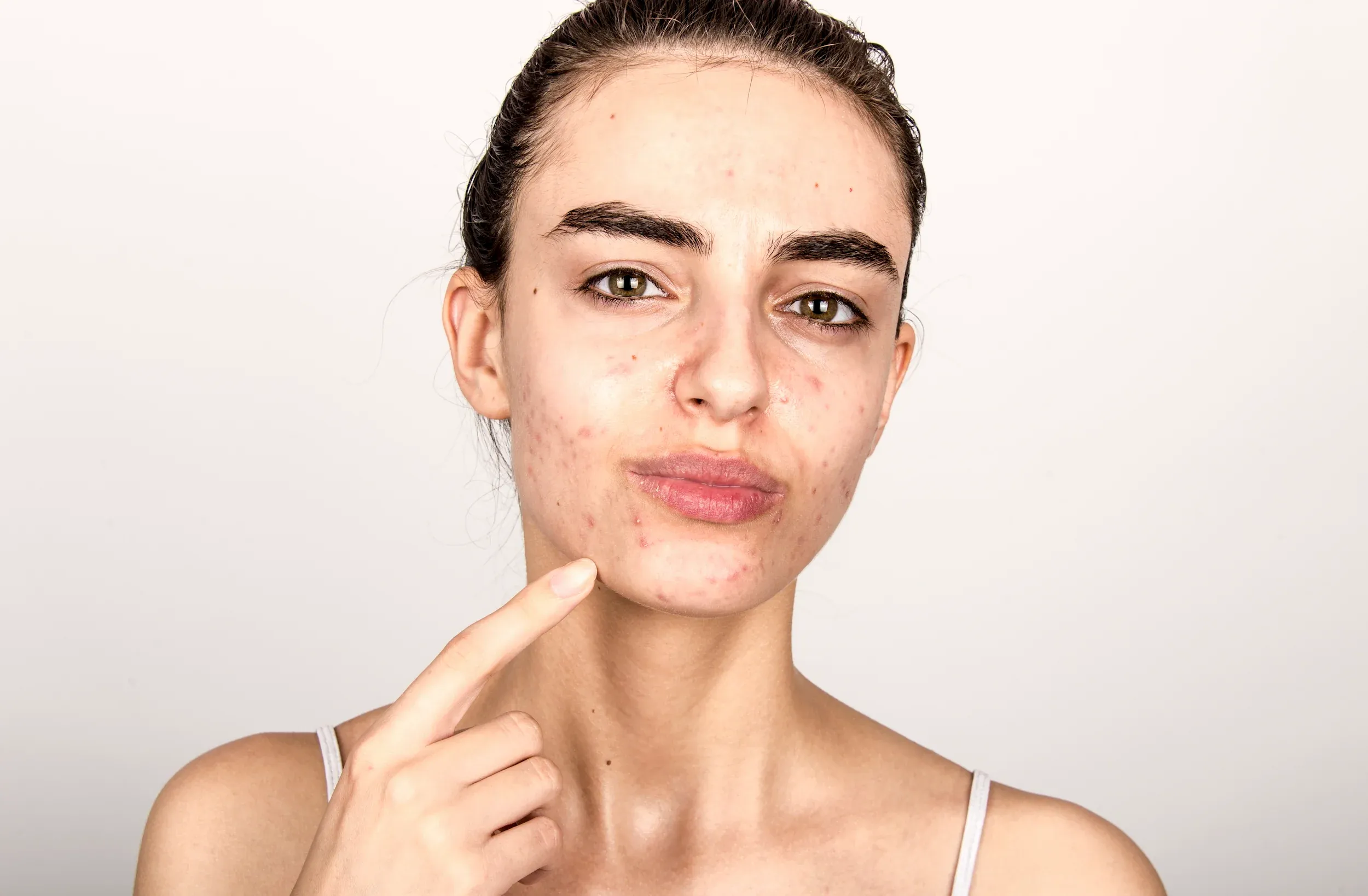 Person addressing acne concerns at Mint Aesthetics & Skin Indianapolis